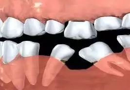 Kapan gigi ompong perlu diganti dengan gigi tiruan  ?