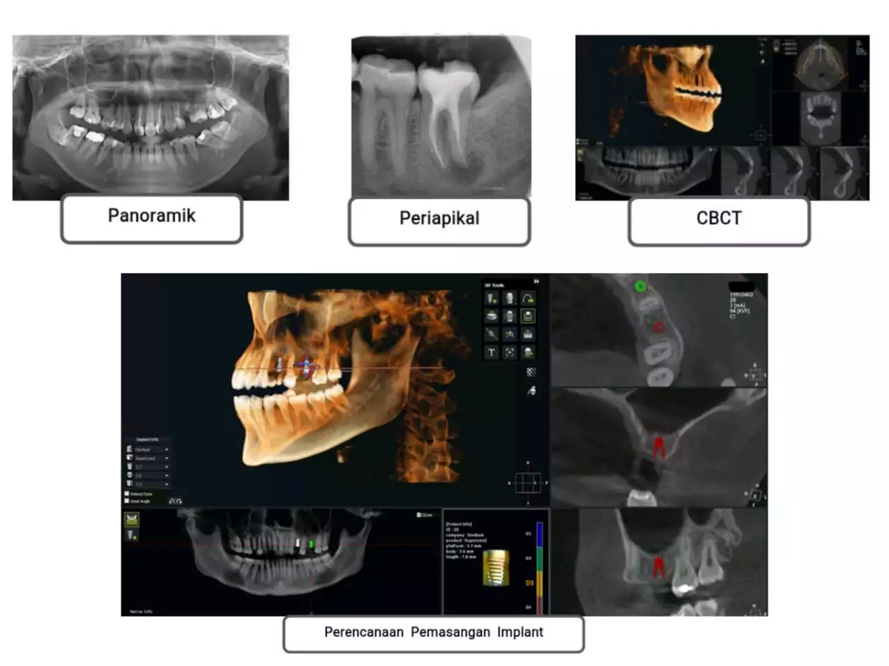 CBCT (Cone Beam Computed Tomography)