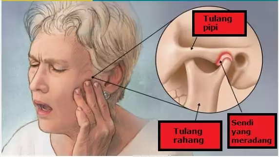 GANGGUAN SENDI RAHANG ( TMJ)