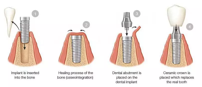  dental implant itu apa?