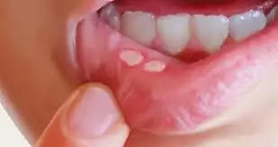 Apa itu Stomatitis Aftosa Rekuren (SAR)?