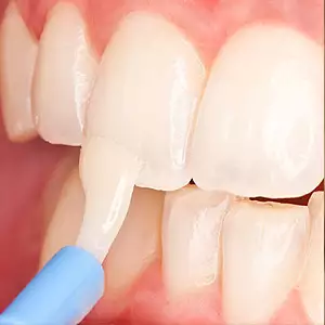 PENGGUNAAN FLUORIDE TOPIKAL GUNA PENCEGAHAN GIGI BERLUBANG